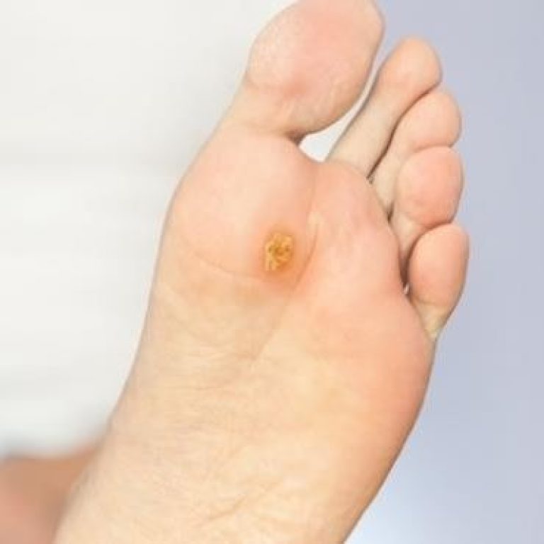 verruga plantar o papiloma1